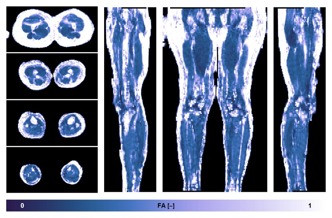 IVIM corrected whole leg muscle fractional anisotropy obtained from diffusion tensor imaging.